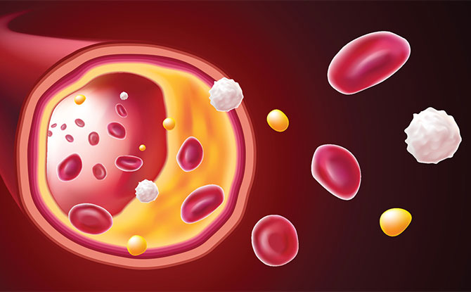 What is Familial Hypercholesterolemia? 